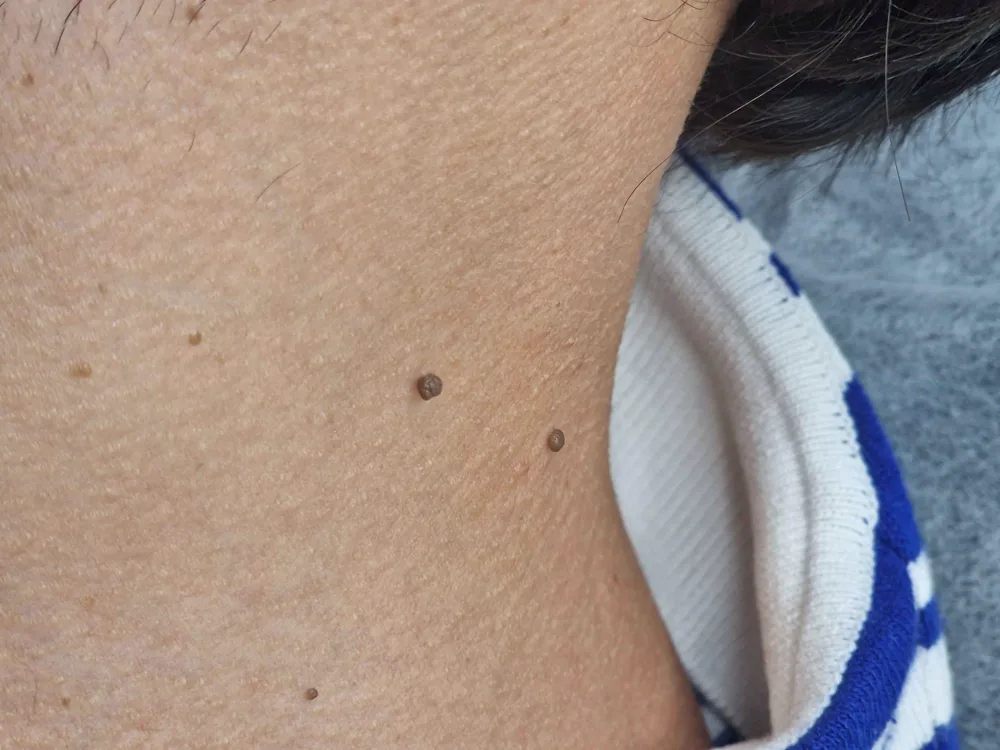 Skin blemish consultation at WOB Beauty