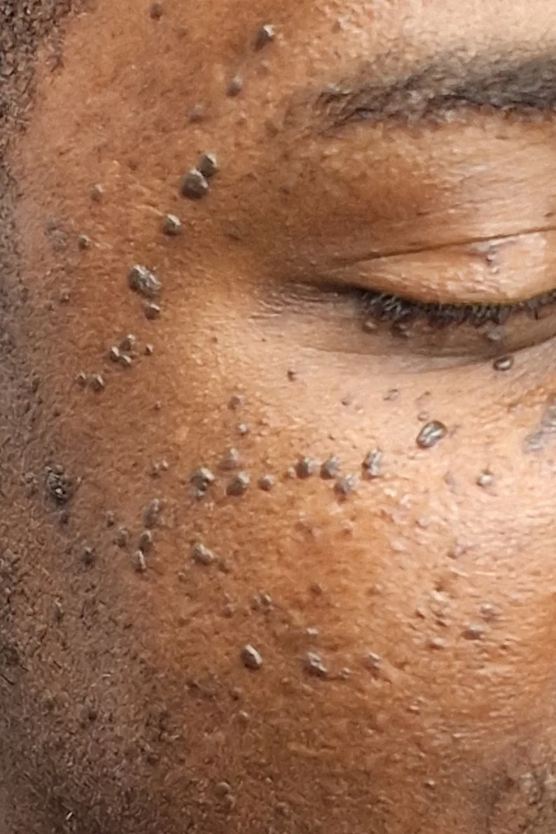 Close view of dermatosis papulosa nigra papules on a client's cheek and temple before treatment