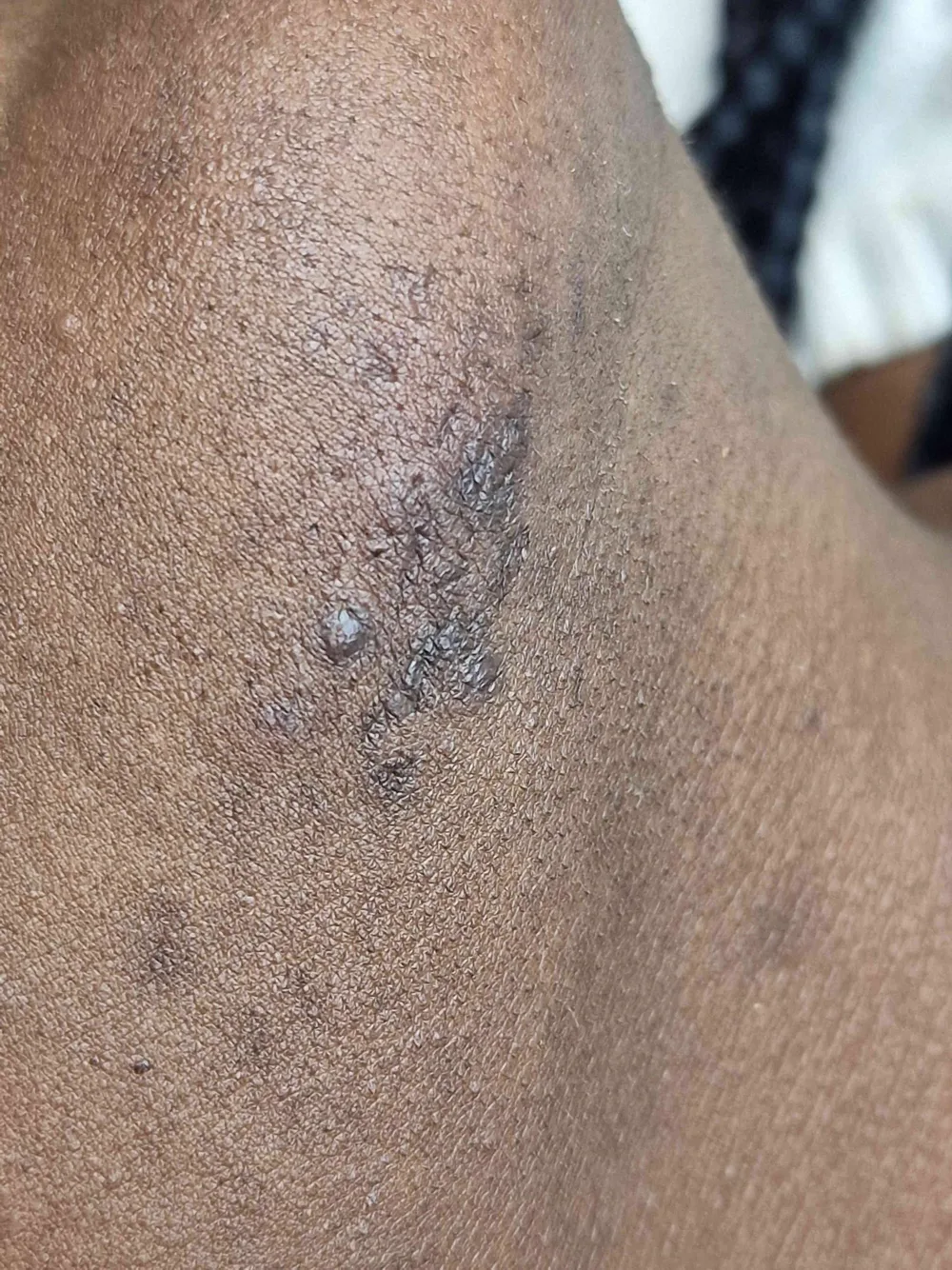 Electrolysis hair removal treatment at WOB Beauty