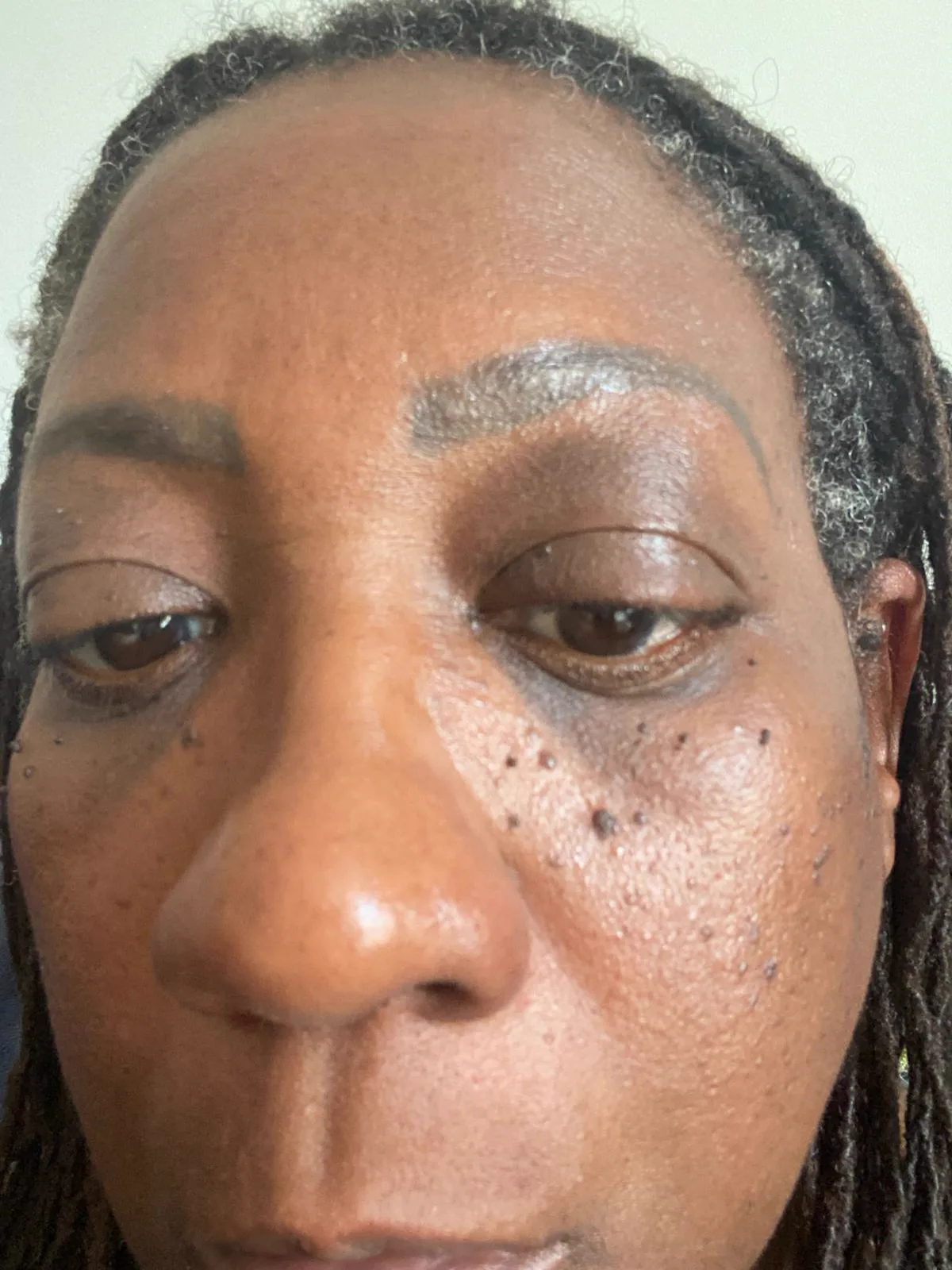 DPN around the eyes before treatment, client four