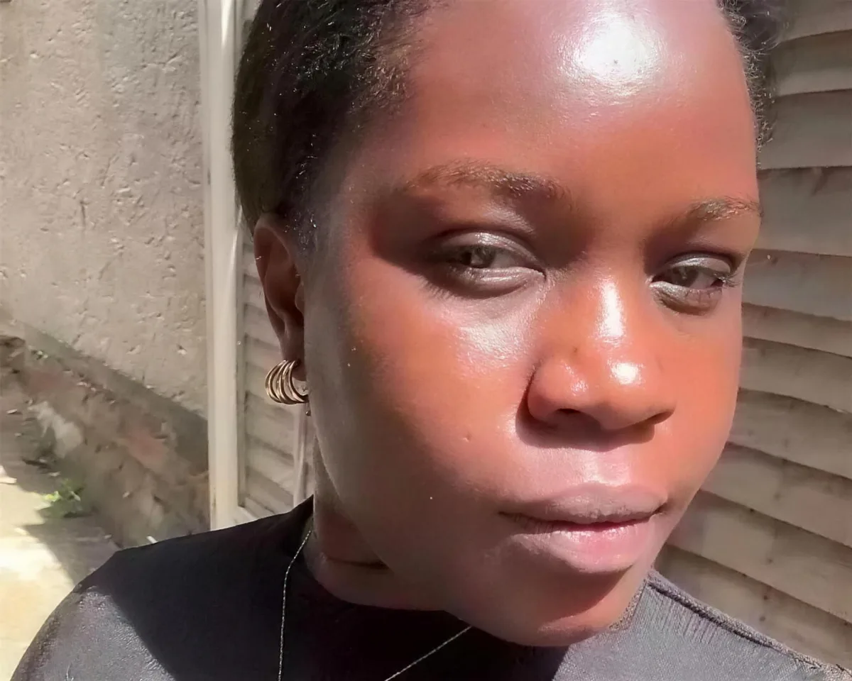 Clear skin after DPN treatment