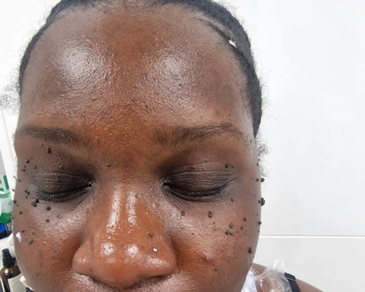 Dense DPN across the forehead and cheeks before treatment