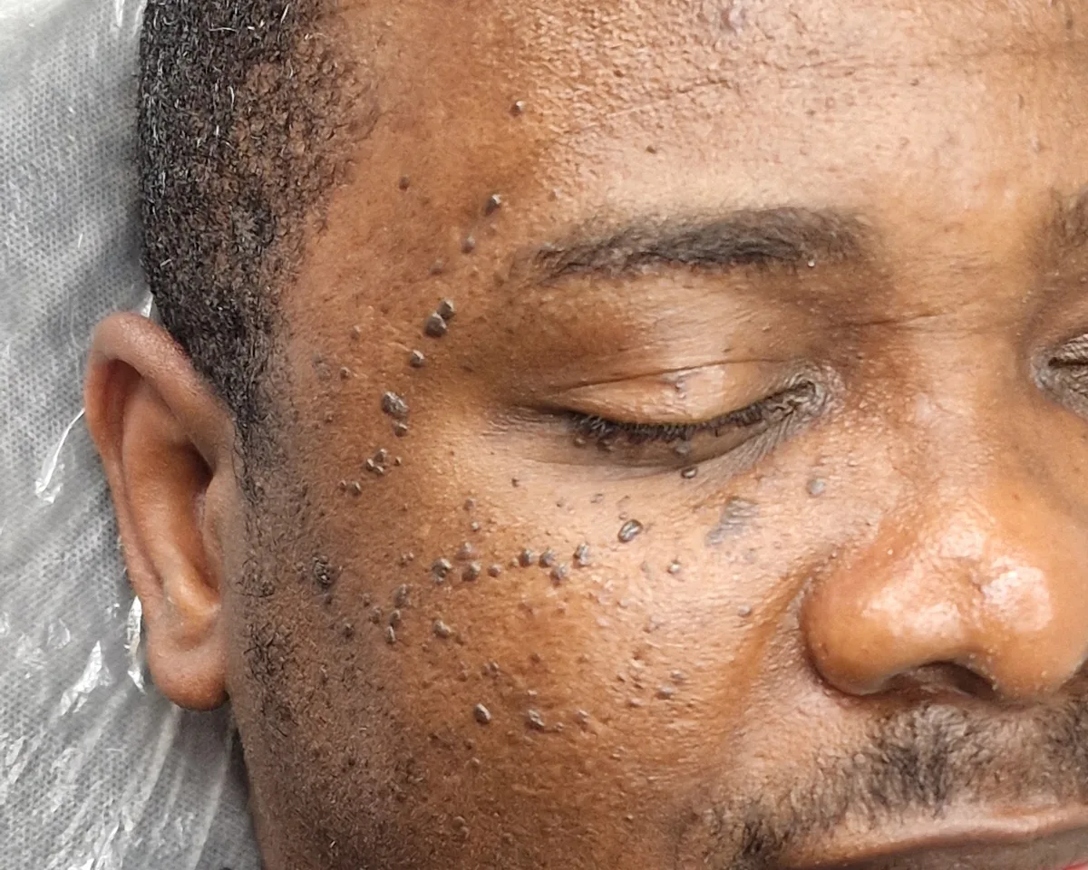 DPN papules on the temple and cheek before treatment