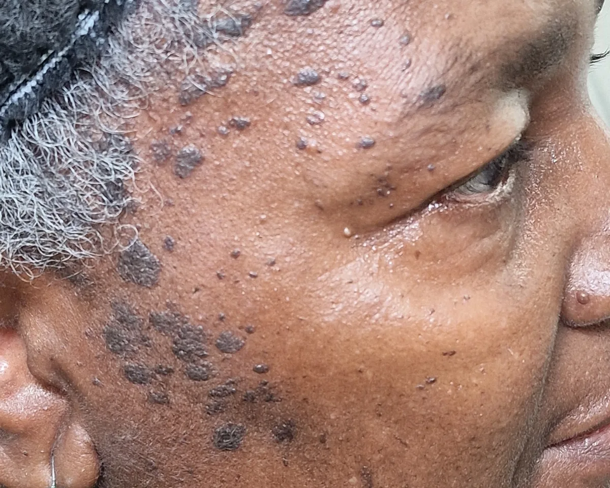 Seborrheic keratosis on the temple and cheek before treatment